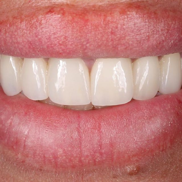 Д-р Ваня Липчева - Пародонтология | Имплантология | Естетика | Dr. Vanya Lipcheva - Periodontology | Implantology | Esthetics